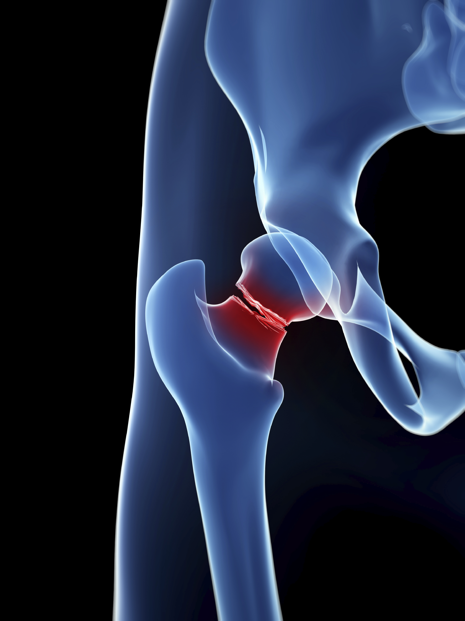 Hip Fractures Among Older Adults